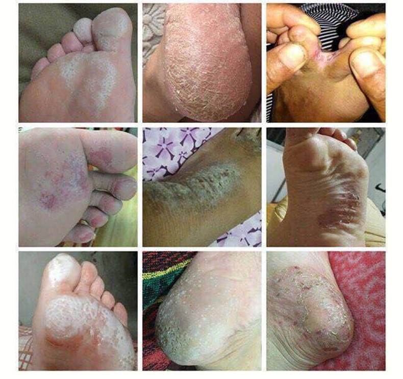 黄氏真菌王正品官网脚气脚臭脱皮烂脚丫水泡型止痒抑杀菌软膏药膏